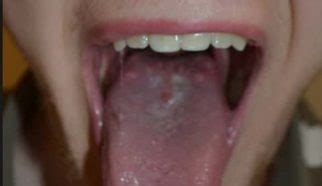 Main Causes of Large Bumps on Back of the Tongue | IYTmed.com