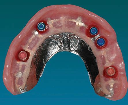 The Case for Implant-Retained, Tissue-Supported Overdentures - Decisions in Dentistry