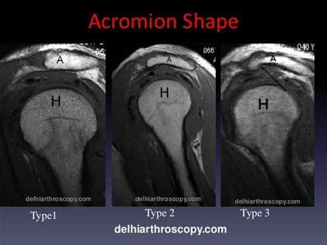 Shoulder Mri Scan in Delhi by Dr Shekhar Shrivastav