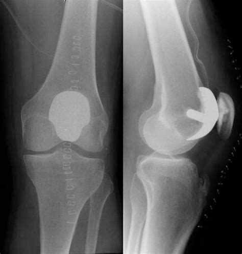 Dissociation of mobile-bearing patellar component in low contact stress patellofemoral ...