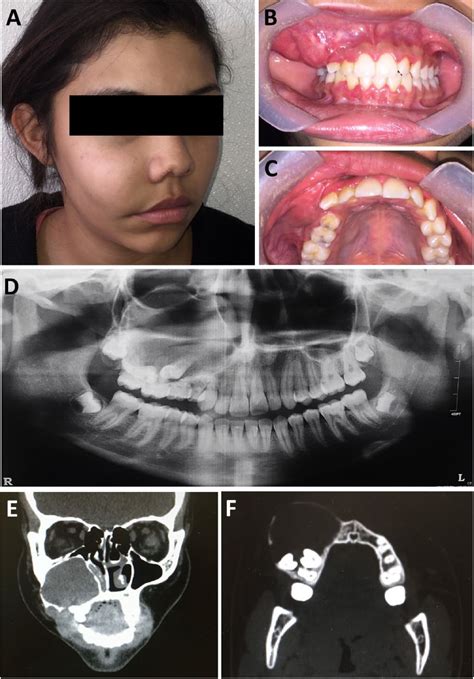 Calcifying Odontogenic Cyst Radiographic