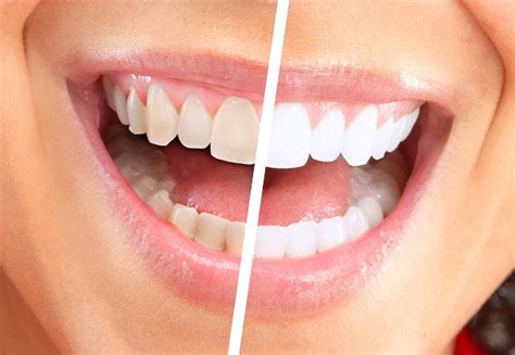 Yellow to Super White → Dental Tips to Make Your Teeth Whiter