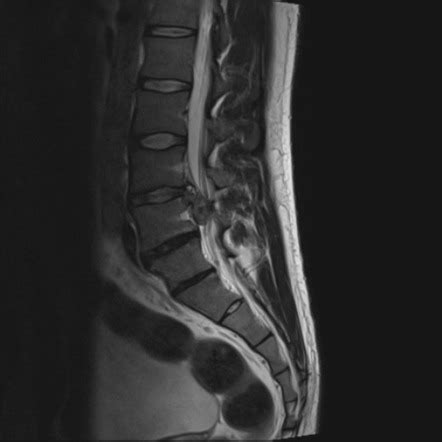 Cauda Equina Syndrome Mri : Lumbar Spontaneous Pyogenic Epidural Spinal ...