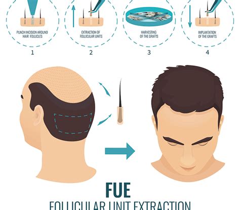 FUE Hair Transplants: How Long to See Results - Miami Hair Institute