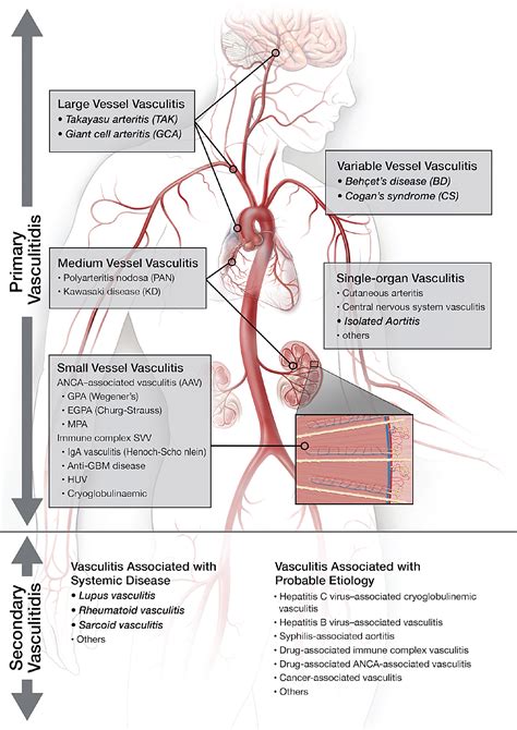 Large-vessel vasculitis | Radiology Key