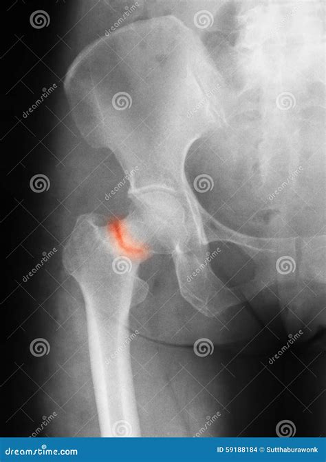 X-ray Image Of Hip Joint, Antero-posterior View, Stock Photography ...