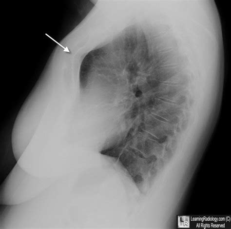 Learning Radiology - Pectus Carinatum