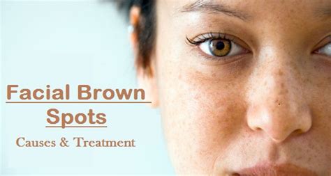 Facial Brown Spots - Causes, Picture, Symptoms And Treatment