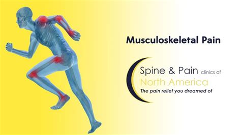 Musculoskeletal Pain Treatment in Fairfax, VA and Potomac, MD | SAPNA ...