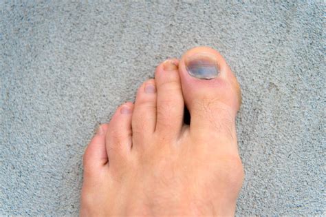 How To Fix A Dead Toenail: A 4-Step Ultimate Guide