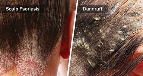 Psoriasis Scalp Flakes