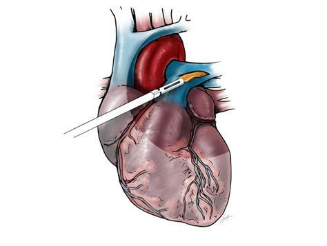 Pulmonary Endarterectomy | Baylor Medicine