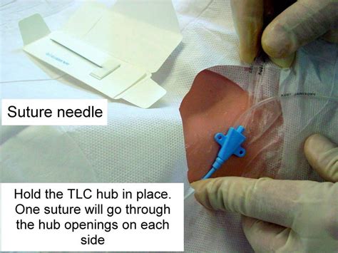 Clinical Notes: Central Line Placement: A Step-by-Step Procedure Guide ...