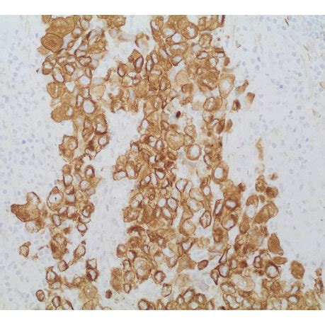 Lymph node biopsy. The malignant cells are strongly positive with ...