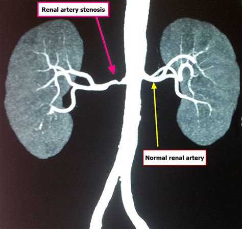 Renal Artery Function - Renal artery stenosis and Renal artery aneurysm