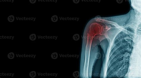 x-ray fracture of acromion process and neck of humerus 6755141 Stock Photo at Vecteezy