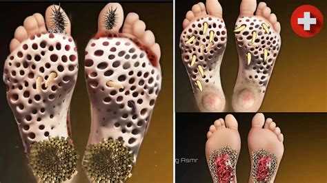 ASMR Remove Maggots & Worm Infected Foot 🦶 | ASMR Animation Treatment Video | Trypophobia ...