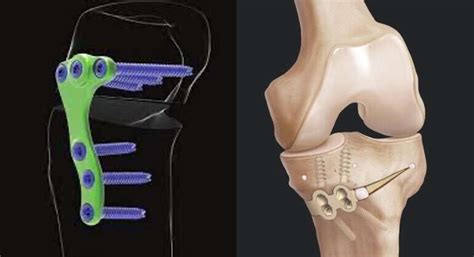 High Tibial Osteotomy: Separating Fact From Fiction in Joe Rogan’s ...