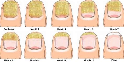 fingernail fungus image | Toenail fungus, Toenail fungus remedies, Fingernail fungus