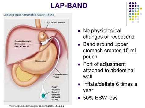 PPT - Complications and Benefits of Bariatric Surgery PowerPoint Presentation - ID:379688