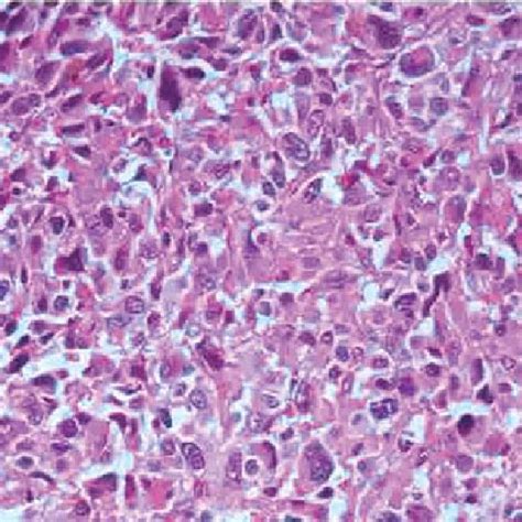 Photomicrograph of malignant fibrous histiocytoma showing fascicular... | Download Scientific ...