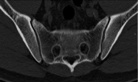 Sacroiliitis – Findings on Conventional Radiography, CT and MRI studies | Semantic Scholar