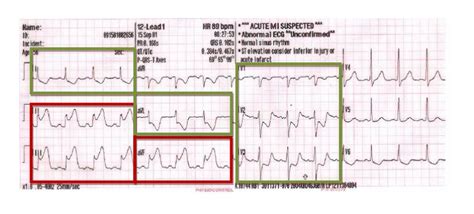 Reciprocal Changes in 12-Lead with Acute STEMI | EMTLife