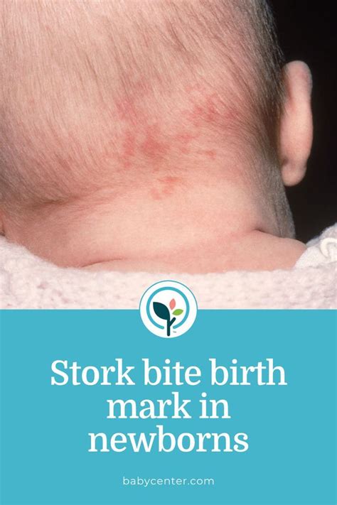 Stork bite: What to know about nevus simplex in babies in 2022 | Baby ...