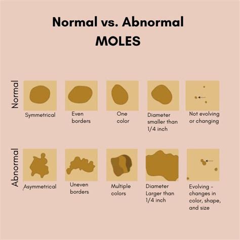 Normal Moles Vs Abnormal Moles