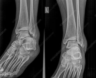 Ankle x-ray - Stock Image - C019/7315 - Science Photo Library