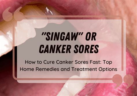 How to Cure Canker Sores Fast: Top Home Remedies and Treatment Options