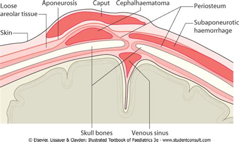 Subgaleal Hemorrhage Ultrasound