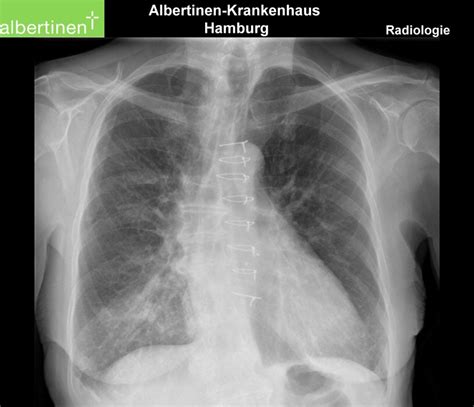 Aspiration Pneumonia On X Ray