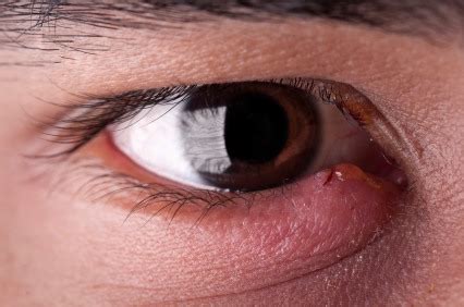 Ayurvedic remedies for seasonal eye inflammation-Stye