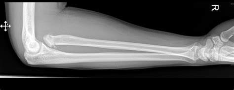 Proximal radial head fracture splint - lerymagazines