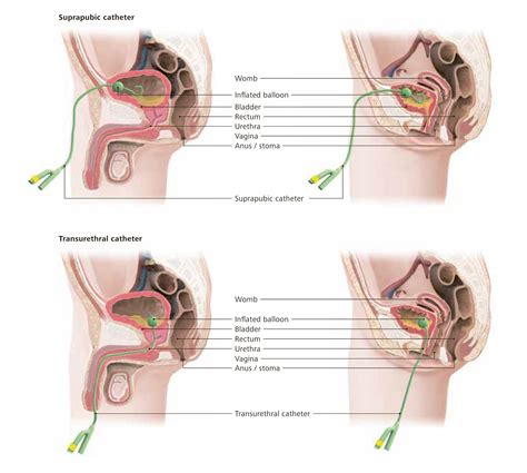 Indwelling Catheter