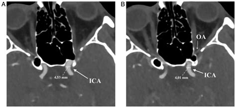 Morphometric study regarding ophthalmic and internal carotid arteries utilizing computed ...