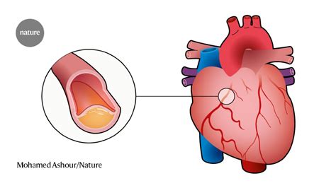 A graphical guide to ischaemic heart disease