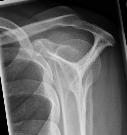 Acromial types | Radiology Reference Article | Radiopaedia.org