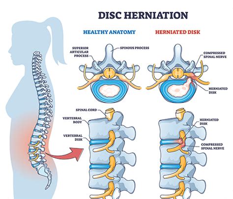 Slipped Disc Treatment, Symptoms & Causes | ANSSI