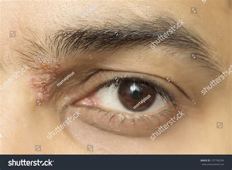 Herpes Zoster Ophthalmicus Eye Herpetic Cold Stock Photo 157796294 - Shutterstock