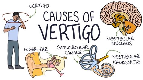 Understanding the Causes of Vertigo - YouTube | Vertigo, Vertigo causes, Medicine book