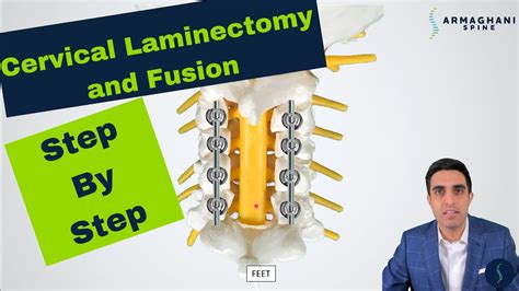 Posterior Cervical Laminectomy and Fusion - Procedure details, recovery, and expectations. - YouTube