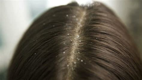 What causes dandruff in Head, Eyebrows, Hair Symptoms and Dry Scalp – BeautyClue