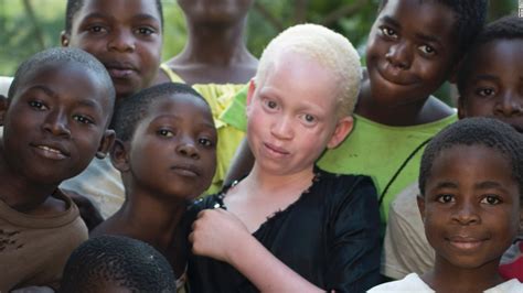 Hunting for humans: African albinos live in fear - CNN.com