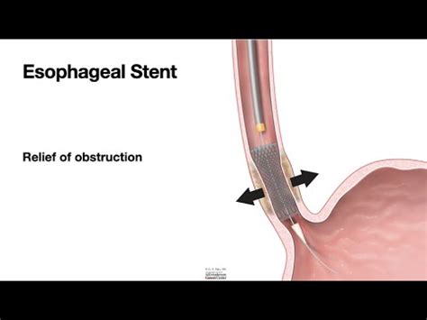 HCC 1475-40-Esophageal Stent - YouTube