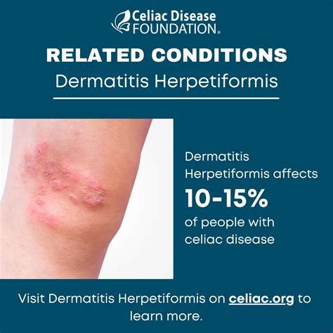 Celiac Disease Foundation Dermatitis Herpetiformis, Also, 59% OFF