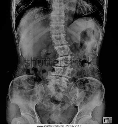 Scoliosis Film Xray Lumbar Spine Ap Stock Photo (Edit Now) 298479116