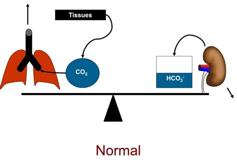 Clinical Interpretation Of Arterial Blood Gases – What I've Learned As ...