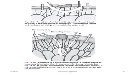 Principles of bowel anastomosis